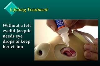 Lifelong TreatmentLifelong Treatment
Without a left
eyelid Jacquie
needs eye
drops to keep
her vision
 