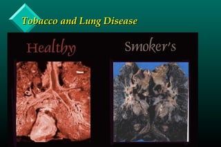 Tobacco and Lung DiseaseTobacco and Lung Disease
 