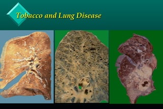 Tobacco and Lung DiseaseTobacco and Lung Disease
 