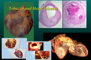 Tobacco and Heart DiseaseTobacco and Heart Disease
 