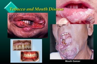 Tobacco and Mouth DiseaseTobacco and Mouth Disease
 