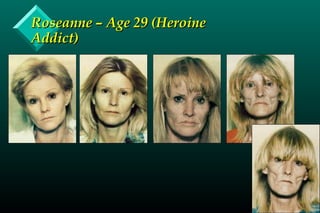 Roseanne – Age 29 (HeroineRoseanne – Age 29 (Heroine
Addict)Addict)
 
