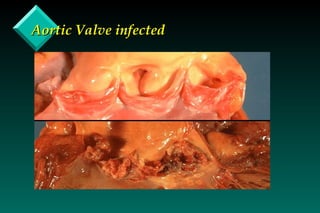 Aortic Valve infected 