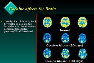 Cocaine affects the Brain … study of K. Little et al; Am J Psychiatry on post mortem brain tissue of chronic users – dopamine transporter proteins (VMAT2) reduced 