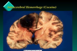 Intracerebral Hemorrhage (Cocaine) 