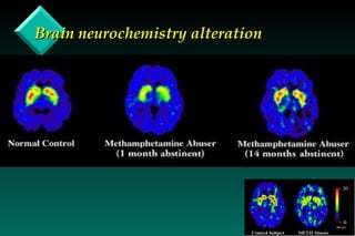 Brain neurochemistry alteration 