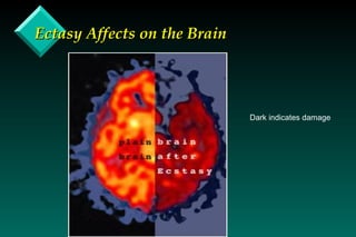 Ectasy Affects on the Brain Dark indicates damage 