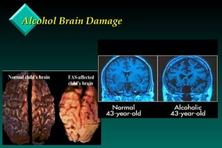 Alcohol Brain Damage 