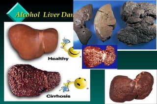 Alcohol  Liver Damage 