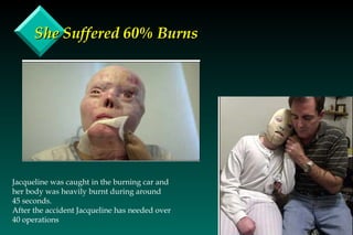 She Suffered 60% Burns Jacqueline was caught in the burning car and her body was heavily burnt during around 45 seconds.  After the accident Jacqueline has needed over 40 operations 
