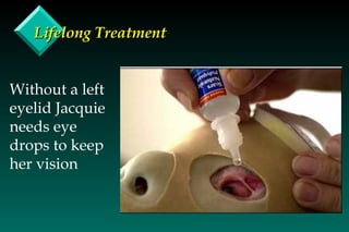 Lifelong Treatment Without a left eyelid Jacquie needs eye drops to keep her vision 