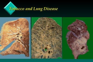 Tobacco and Lung Disease 