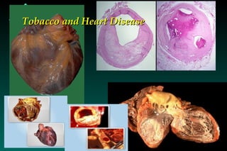 Tobacco and Heart Disease 