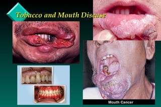 Tobacco and Mouth Disease 