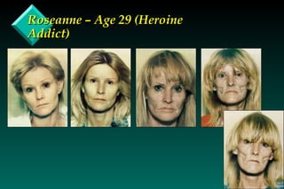Roseanne – Age 29 (Heroine Addict) 