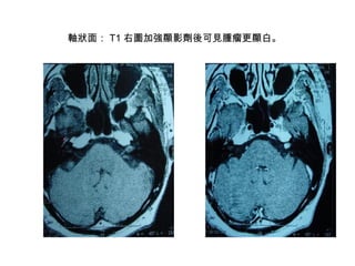 軸狀面： T1 右圖加強顯影劑後可見腫瘤更顯白。   