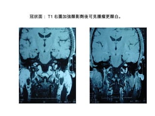 冠狀面： T1 右圖加強顯影劑後可見腫瘤更顯白。   