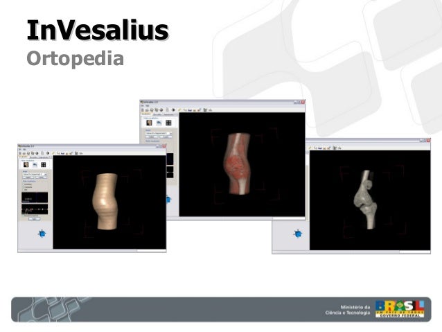 InVesalius: 3D medical imaging software