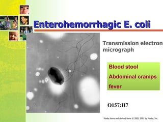 Enterohemorrhagic E. coli O157:H7  Blood stool Abdominal cramps fever Transmission electron  micrograph  