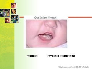 muguet (mycotic stomatitis) 