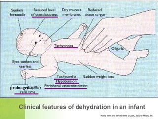 Clinical features of dehydration in an infant prolonged 