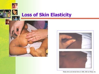 Loss of Skin Elasticity 