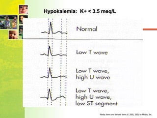 Hypokalemia:  K+ < 3.5 meq/L 