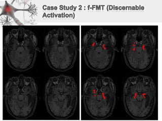 Case Study 2 : f-FMT (Discernable Activation)