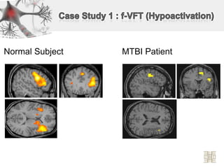 Case Study 1 : f-VFT (Hypoactivation)   Normal Subject     MTBI Patient