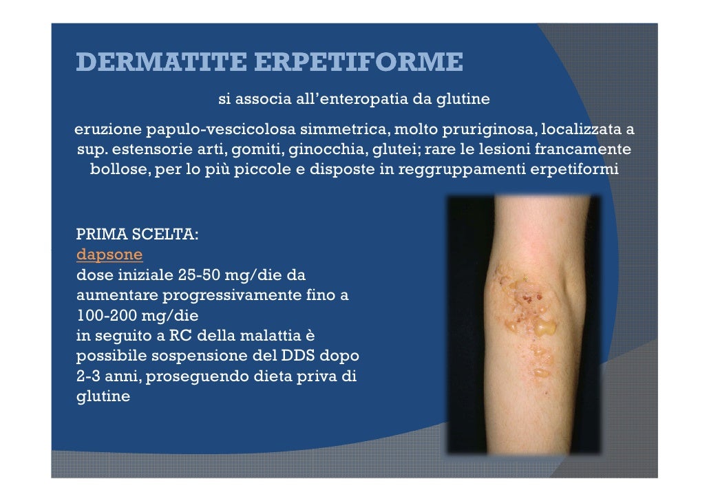 Medicine per cura di psoriasi efficace