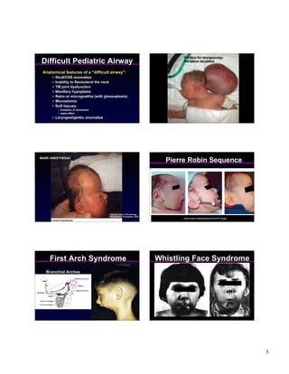 Position for laryngoscopy:
 Difficult Pediatric Airway                                                       left lateral decubitus


 Anatomical features of a "difficult airway":
      •   Skull/CNS anomalies
      •   Inability to flex/extend the neck
      •   TM joint dysfunction
      •   Maxillary hypoplasia
      •   Retro or micrognathia (with glossoptosis)
      •   Microstomia
      •   Soft tissues:
           • limitation of movement
           • mass effect
      • Laryngeal/glottic anomalies




MASK ANESTHESIA!
                !                                                            Pierre Robin Sequence




                                         Clark DA. Atlas of Neonatology
                                         WB Saunders, Philadelphia, 2000
                                                                                  www.scielo.cl/fbpe/img/rcp/v75n1/f1_03.jpg




     First Arch Syndrome                                                   Whistling Face Syndrome
   Branchial Arches




                                                                                                                               3
 