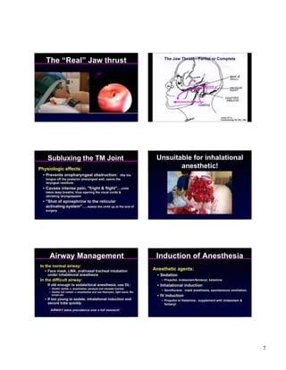 The “Real” Jaw thrust                                                           The Jaw Thrust - Partial or Complete




                                                                                                           Complete




                                                                                                       Partial



                                                                                                                      Larsen CP Jr., Jr.,
                                                                                                                          Larsen CP
                                                                                                                      Anesthesiology 89:1293, 1998
                                                                                                                          Anesthesiology 89:1293, 1998




    Subluxing the TM Joint                                                     Unsuitable for inhalational
Physiologic effects:                                                                  anesthetic!
  • Prevents oropharyngeal obstruction:               lifts the
   tongue off the posterior pharyngeal wall, opens the
   laryngeal vestibule
  • Causes intense pain, "fright & flight"…child
   takes deep breaths, thus opening the vocal cords &
   obviating laryngospasm
  • "Shot of epinephrine to the reticular
    activating system"….wakes the child up at the end of
   surgery




     Airway Management                                                         Induction of Anesthesia
In the normal airway:
   • Face mask, LMA, oral/nasal tracheal intubation
                                                                              Anesthetic agents:
     under inhalational anesthesia                                              • Sedation
In the difficult airway:                                                          • Propofol, midazolam/fentanyl, ketamine
    If old enough to sedate/local anesthesia, use DL:                           • Inhalational induction
     • Glottis visible ⇒ anesthetize, paralyze and intubate trachea
                                                                                  • Sevoflurane: mask anesthesia, spontaneous ventilation,
     • Glottis not visible ⇒ anesthetize and use fiberoptic, light wand, Wu
       scope etc                                                                • IV induction
   • If too young to sedate, inhalational induction and                           • Propofol or Ketamine; supplement with midazolam &
     secure tube quickly                                                            fentanyl
      AIRWAY takes precedence over a full stomach!




                                                                                                                                                         7
 