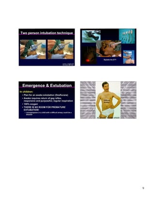 Two person intubation technique




                                                                              Stylette the ETT

                                                    Lerman J, Creighton RE.
                                                    Ped Anesth 2005:16;96




  Emergence & Extubation
In children:
  • Plan for an awake extubation (Desflurane)
  • Awake requires return of gag reflex,
    responsive and purposeful, regular respiration                            Difficult
                                                                              Airway?
  • 100% oxygen
  • THERE IS NO ROOM FOR PREMATURE
    EXTUBATION!
    • Laryngospasm in a child with a difficult airway could be a
      disaster




                                                                                                 9
 