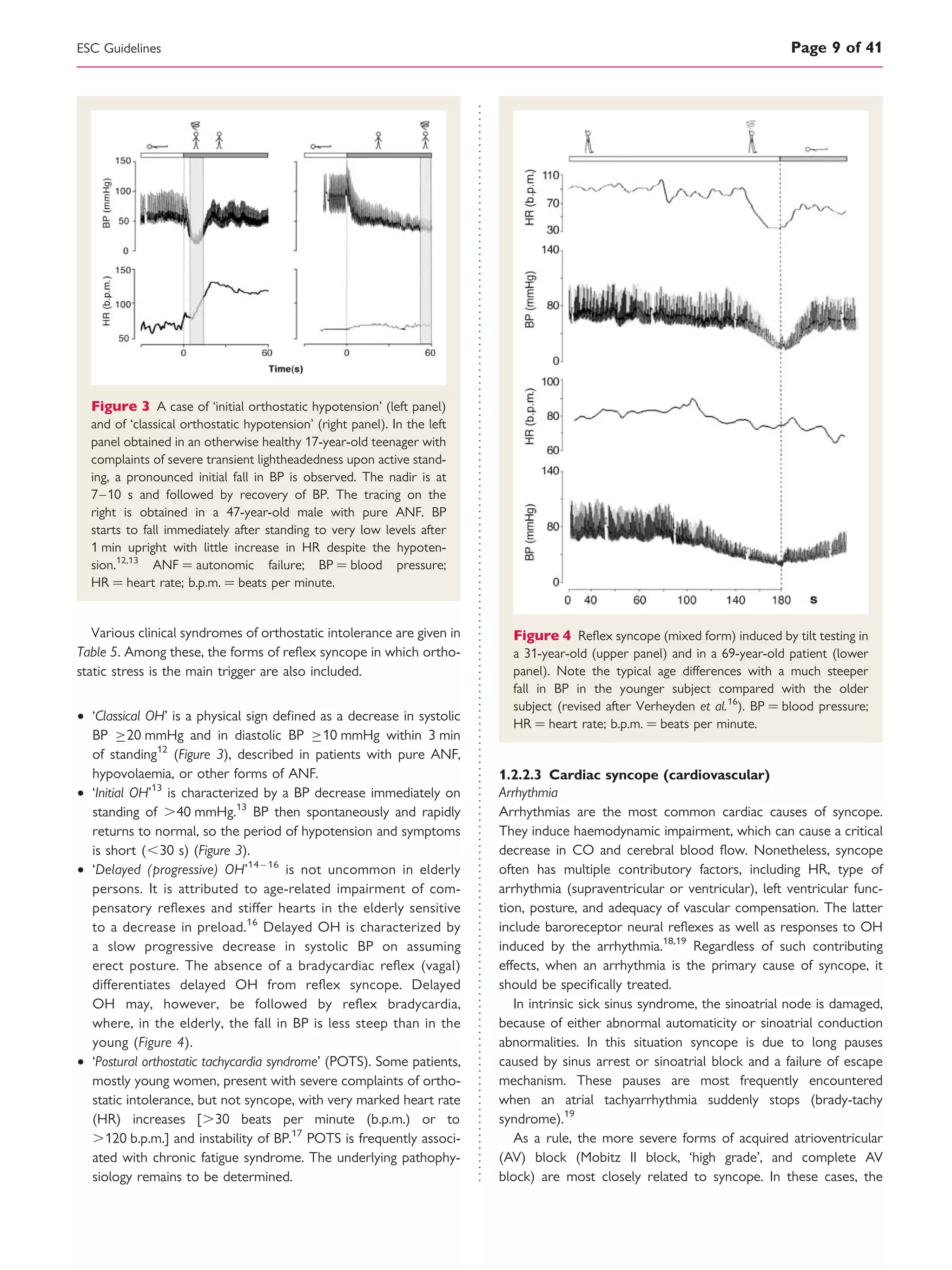Various clinical syndromes of orthostatic intolerance are given in
Table 5. Among these, the forms of reﬂex syncope in which ortho-
static stress is the main trigger are also included.
† ‘Classical OH’ is a physical sign deﬁned as a decrease in systolic
BP 20 mmHg and in diastolic BP 10 mmHg within 3 min
of standing12
(Figure 3), described in patients with pure ANF,
hypovolaemia, or other forms of ANF.
† ‘Initial OH’13
is characterized by a BP decrease immediately on
standing of .40 mmHg.13
BP then spontaneously and rapidly
returns to normal, so the period of hypotension and symptoms
is short (,30 s) (Figure 3).
† ‘Delayed (progressive) OH’14 – 16
is not uncommon in elderly
persons. It is attributed to age-related impairment of com-
pensatory reﬂexes and stiffer hearts in the elderly sensitive
to a decrease in preload.16
Delayed OH is characterized by
a slow progressive decrease in systolic BP on assuming
erect posture. The absence of a bradycardiac reﬂex (vagal)
differentiates delayed OH from reﬂex syncope. Delayed
OH may, however, be followed by reﬂex bradycardia,
where, in the elderly, the fall in BP is less steep than in the
young (Figure 4).
† ‘Postural orthostatic tachycardia syndrome’ (POTS). Some patients,
mostly young women, present with severe complaints of ortho-
static intolerance, but not syncope, with very marked heart rate
(HR) increases [.30 beats per minute (b.p.m.) or to
.120 b.p.m.] and instability of BP.17
POTS is frequently associ-
ated with chronic fatigue syndrome. The underlying pathophy-
siology remains to be determined.
1.2.2.3 Cardiac syncope (cardiovascular)
Arrhythmia
Arrhythmias are the most common cardiac causes of syncope.
They induce haemodynamic impairment, which can cause a critical
decrease in CO and cerebral blood ﬂow. Nonetheless, syncope
often has multiple contributory factors, including HR, type of
arrhythmia (supraventricular or ventricular), left ventricular func-
tion, posture, and adequacy of vascular compensation. The latter
include baroreceptor neural reﬂexes as well as responses to OH
induced by the arrhythmia.18,19
Regardless of such contributing
effects, when an arrhythmia is the primary cause of syncope, it
should be speciﬁcally treated.
In intrinsic sick sinus syndrome, the sinoatrial node is damaged,
because of either abnormal automaticity or sinoatrial conduction
abnormalities. In this situation syncope is due to long pauses
caused by sinus arrest or sinoatrial block and a failure of escape
mechanism. These pauses are most frequently encountered
when an atrial tachyarrhythmia suddenly stops (brady-tachy
syndrome).19
As a rule, the more severe forms of acquired atrioventricular
(AV) block (Mobitz II block, ‘high grade’, and complete AV
block) are most closely related to syncope. In these cases, the
Figure 3 A case of ‘initial orthostatic hypotension’ (left panel)
and of ‘classical orthostatic hypotension’ (right panel). In the left
panel obtained in an otherwise healthy 17-year-old teenager with
complaints of severe transient lightheadedness upon active stand-
ing, a pronounced initial fall in BP is observed. The nadir is at
7–10 s and followed by recovery of BP. The tracing on the
right is obtained in a 47-year-old male with pure ANF. BP
starts to fall immediately after standing to very low levels after
1 min upright with little increase in HR despite the hypoten-
sion.12,13
ANF ¼ autonomic failure; BP ¼ blood pressure;
HR ¼ heart rate; b.p.m. ¼ beats per minute.
Figure 4 Reﬂex syncope (mixed form) induced by tilt testing in
a 31-year-old (upper panel) and in a 69-year-old patient (lower
panel). Note the typical age differences with a much steeper
fall in BP in the younger subject compared with the older
subject (revised after Verheyden et al.16
). BP ¼ blood pressure;
HR ¼ heart rate; b.p.m. ¼ beats per minute.
ESC Guidelines Page 9 of 41
 