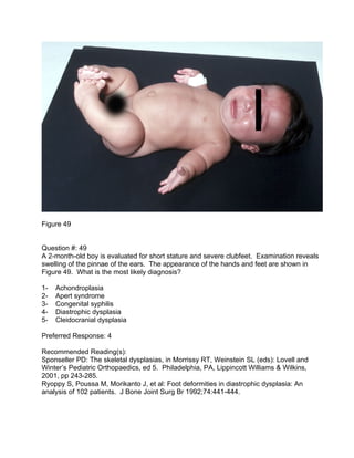 Figure 49


Question #: 49
A 2-month-old boy is evaluated for short stature and severe clubfeet. Examination reveals
swell...