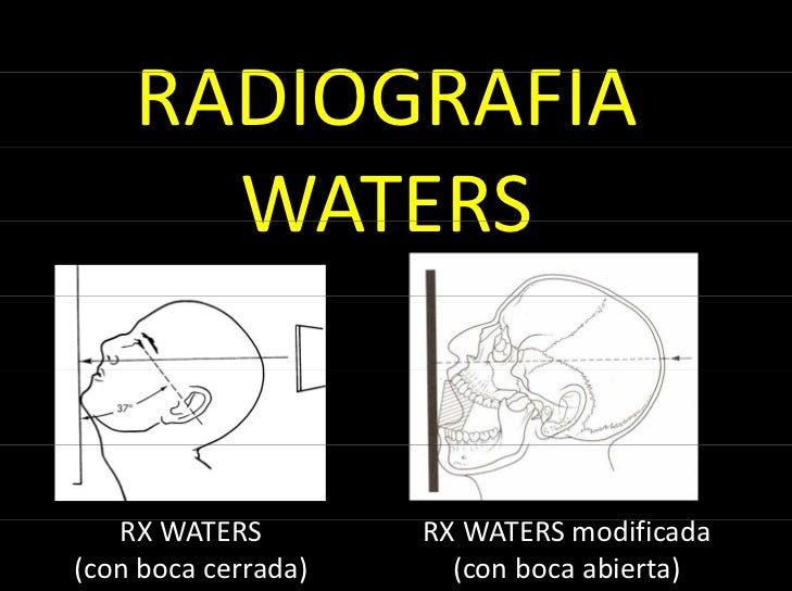 Resultado de imagen para radiografia waters