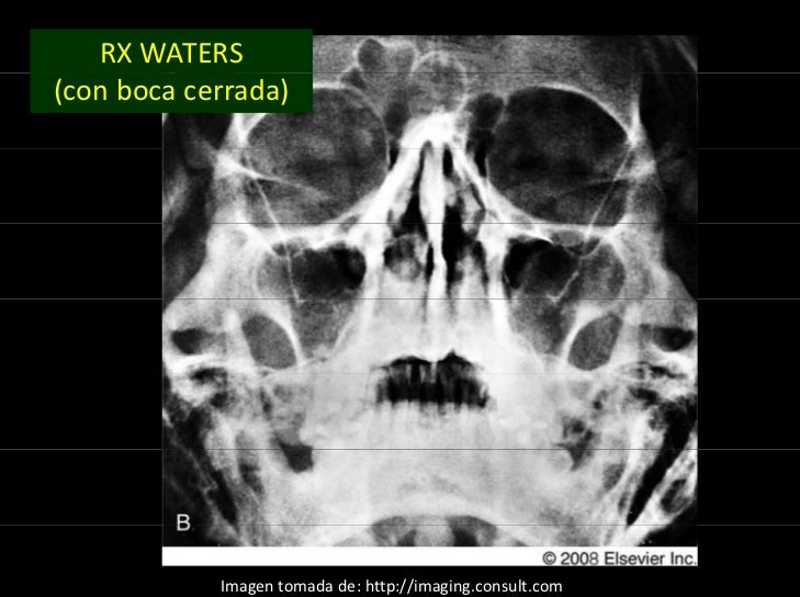 RXÂ WATERS
(con boca cerrada)
Imagen tomada de: http://imaging.consult.com
