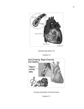 12

Jantung yang terkena clot
Gambar 2.8
Jantung yang hampir tertutup arterinya
Gambar 2.9
 