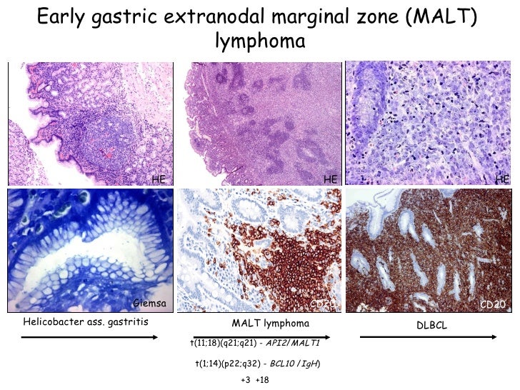 Modern classification of lymphomas (2010) VEAB presentation