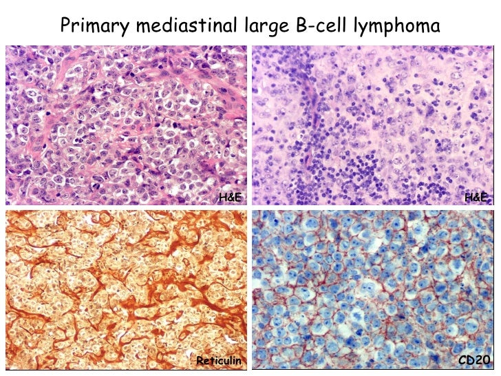 actually, leadership primary mediastinal b cell lymphoma symptoms testes are not
