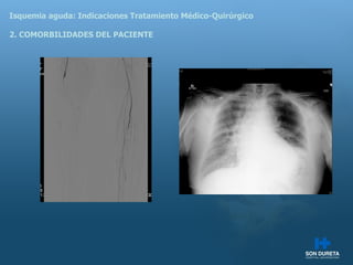Isquemia aguda: Indicaciones Tratamiento M édico-Quirúrgico 2. COMORBILIDADES DEL PACIENTE 