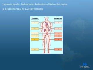 Isquemia aguda:  Indicaciones Tratamiento M édico-Quirúrgico 3. DISTRIBUCIÓN DE LA ENFERMEDAD TROMBOSIS EMBOLIAS 