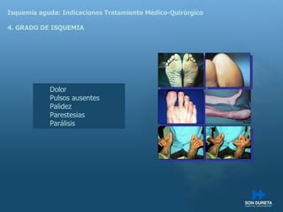 Isquemia aguda: Indicaciones Tratamiento M édico-Quirúrgico 4. GRADO DE ISQUEMIA Dolor Pulsos ausentes Palidez Parestesias Par álisis 