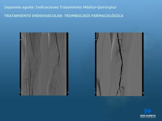 Isquemia aguda: Indicaciones Tratamiento M édico-Quirúrgico TRATAMIENTO ENDOVASCULAR: TROMBOLISIS FARMACOLÓGICA 