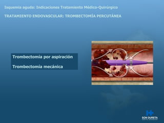 Isquemia aguda: Indicaciones Tratamiento M édico-Quirúrgico TRATAMIENTO ENDOVASCULAR: TROMBECTOMÍA PERCUTÁNEA Trombectomía por aspiración Trombectomía mecánica 