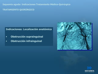 Isquemia aguda: Indicaciones Tratamiento M édico-Quirúrgico TRATAMIENTO QUIRÚRGICO Indicaciones:  Localización anatómica Obstrucción suprainguinal Obstrucción infrainguinal 