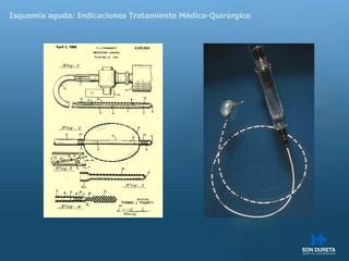 Isquemia aguda: Indicaciones Tratamiento M édico-Quirúrgico 