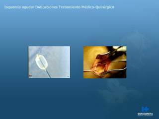 Isquemia aguda: Indicaciones Tratamiento M édico-Quirúrgico 