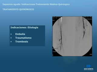 Isquemia aguda: Indicaciones Tratamiento M édico-Quirúrgico TRATAMIENTO QUIRÚRGICO Indicaciones:  Etiología Embolia Traumatismo Trombosis 