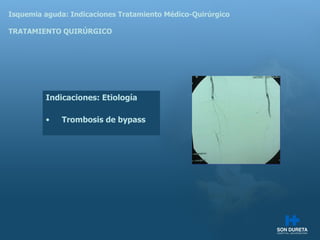 Isquemia aguda: Indicaciones Tratamiento M édico-Quirúrgico TRATAMIENTO QUIRÚRGICO Indicaciones:  Etiología Trombosis de bypass 